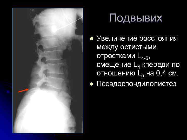 Подвывих l l Увеличение расстояния между остистыми отростками L 4 -5, смещение L 4