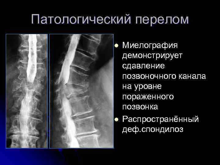 Патологический перелом l l Миелография демонстрирует сдавление позвоночного канала на уровне пораженного позвонка Распространённый