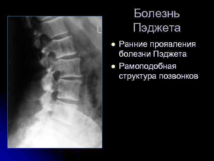 Болезнь Пэджета l l Ранние проявления болезни Пэджета Рамоподобная структура позвонков 