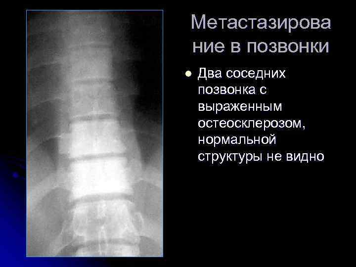 Метастазирова ние в позвонки l Два соседних позвонка с выраженным остеосклерозом, нормальной структуры не