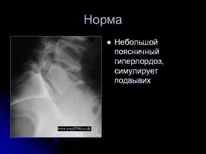 Норма l Небольшой поясничный гиперлордоз, симулирует подвывих 