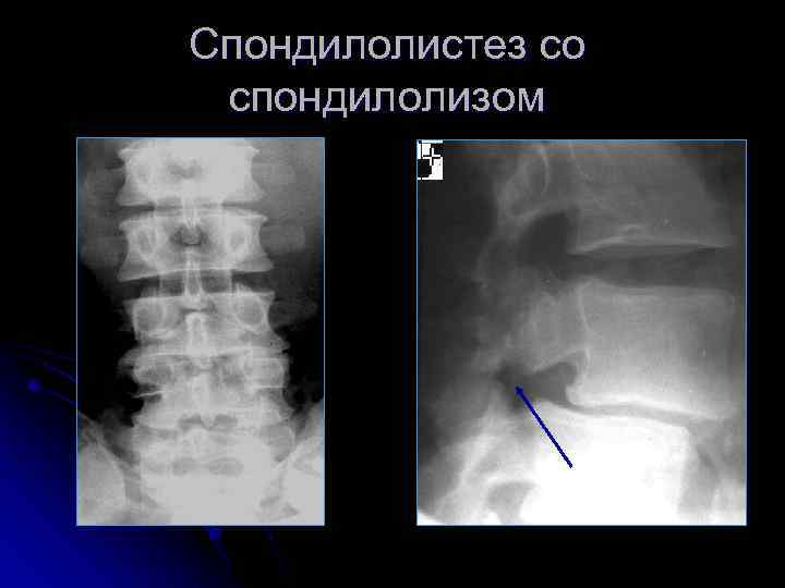 Спондилолистез со спондилолизом 