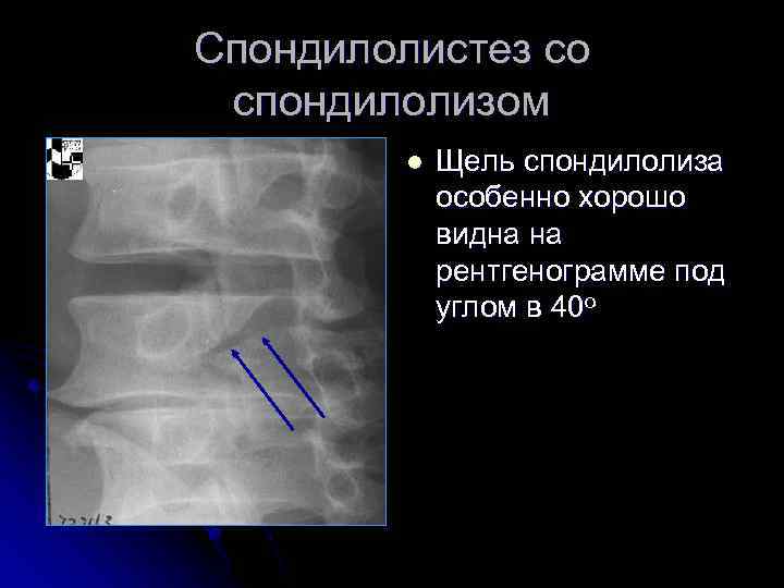 Спондилолистез со спондилолизом l Щель спондилолиза особенно хорошо видна на рентгенограмме под углом в