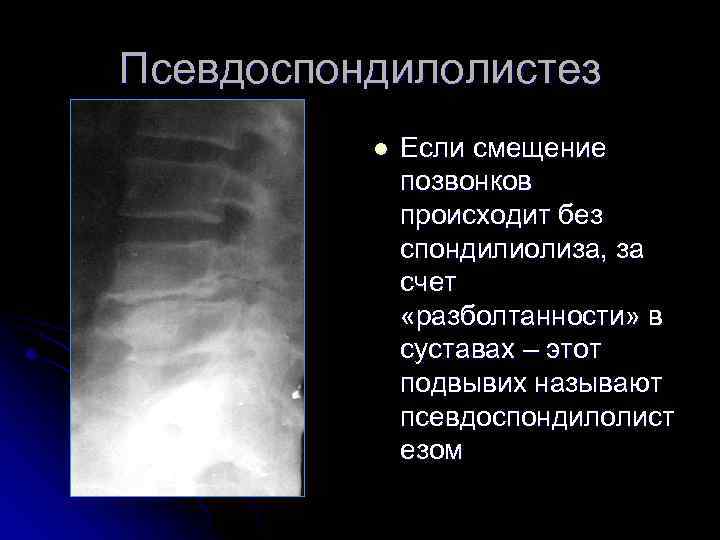 Псевдоспондилолистез l Если смещение позвонков происходит без спондилиолиза, за счет «разболтанности» в суставах –