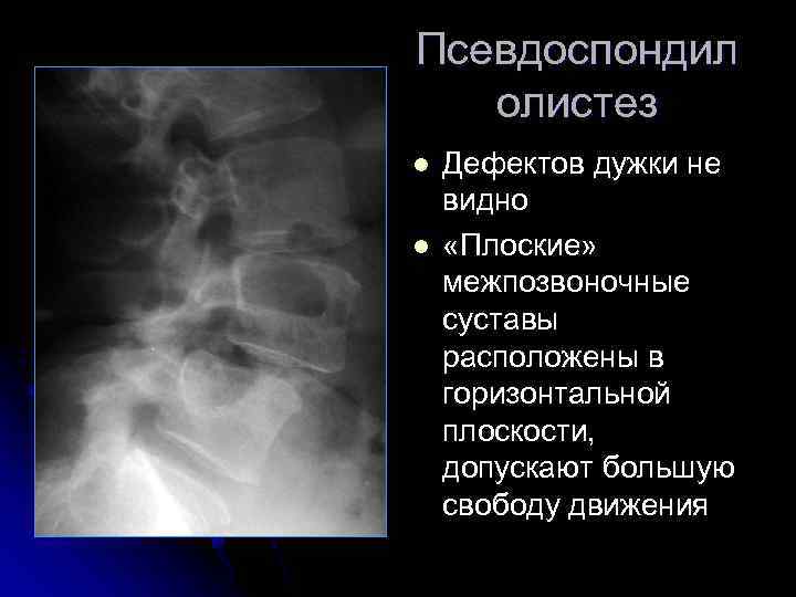 Псевдоспондил олистез l l Дефектов дужки не видно «Плоские» межпозвоночные суставы расположены в горизонтальной