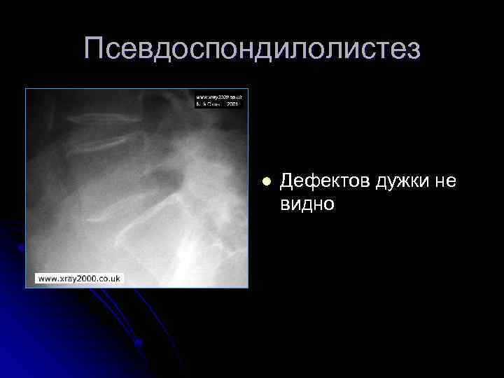 Псевдоспондилолистез l Дефектов дужки не видно 