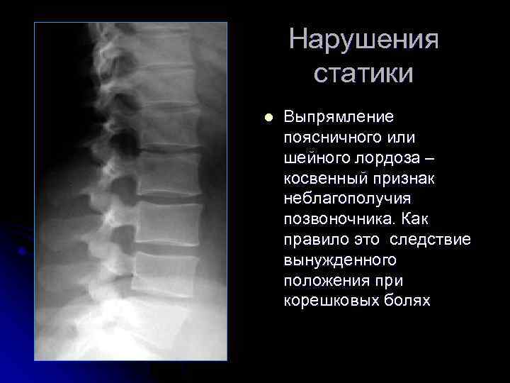 Нарушения статики l Выпрямление поясничного или шейного лордоза – косвенный признак неблагополучия позвоночника. Как