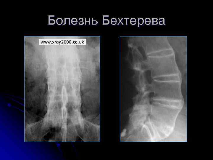 Болезнь Бехтерева 