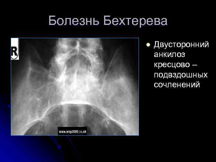 Болезнь Бехтерева l Двусторонний анкилоз кресцово – подвздошных сочленений 