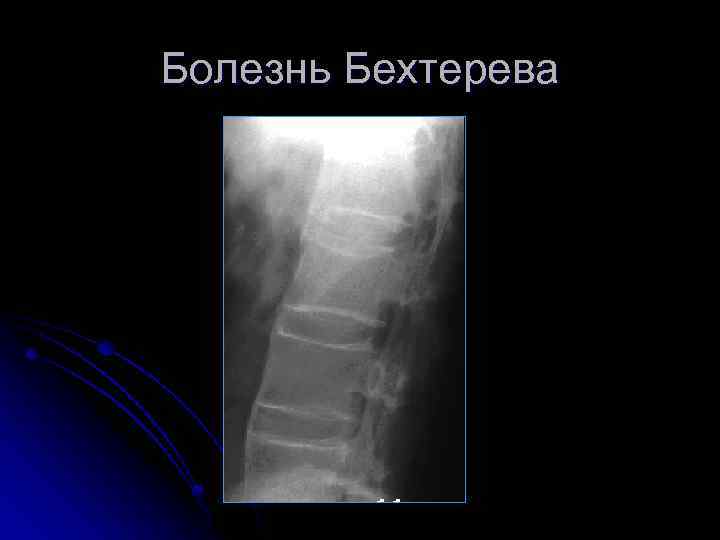 Болезнь Бехтерева 