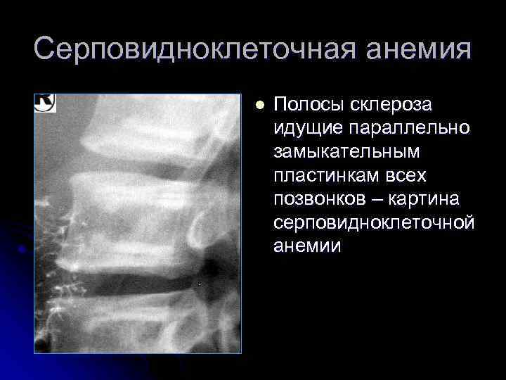 Серповидноклеточная анемия l Полосы склероза идущие параллельно замыкательным пластинкам всех позвонков – картина серповидноклеточной