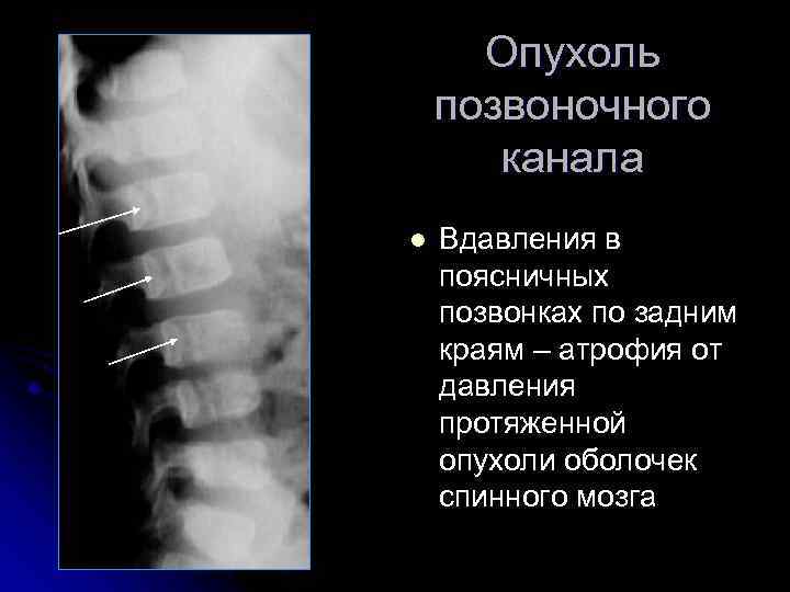 Опухоль позвоночного канала l Вдавления в поясничных позвонках по задним краям – атрофия от