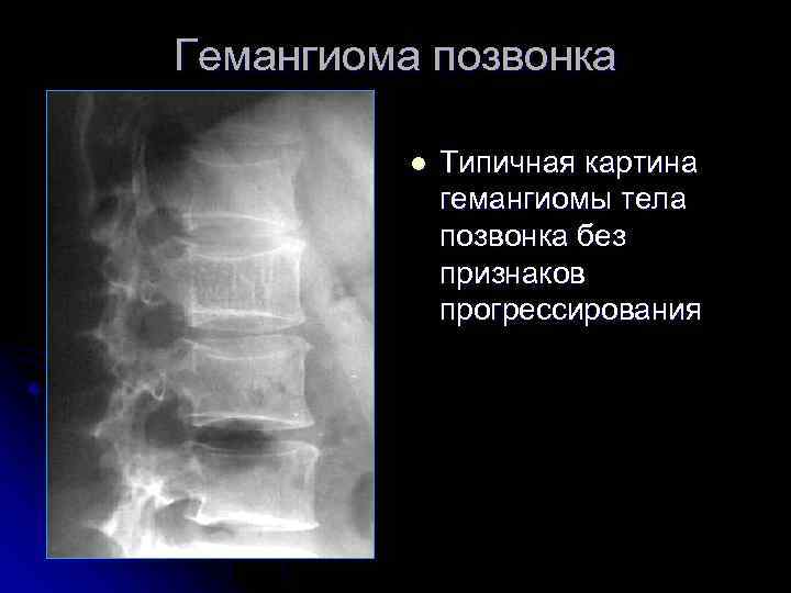 Гемангиома позвонка l Типичная картина гемангиомы тела позвонка без признаков прогрессирования 