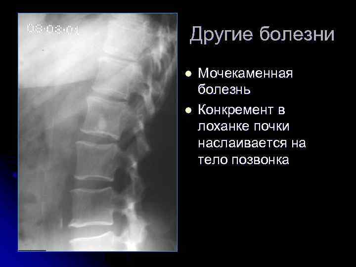 Другие болезни l l Мочекаменная болезнь Конкремент в лоханке почки наслаивается на тело позвонка