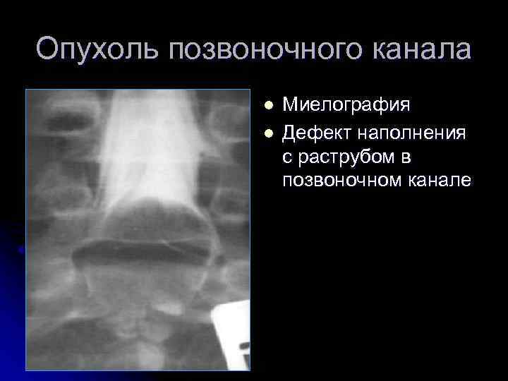 Опухоль позвоночного канала l l Миелография Дефект наполнения с раструбом в позвоночном канале 