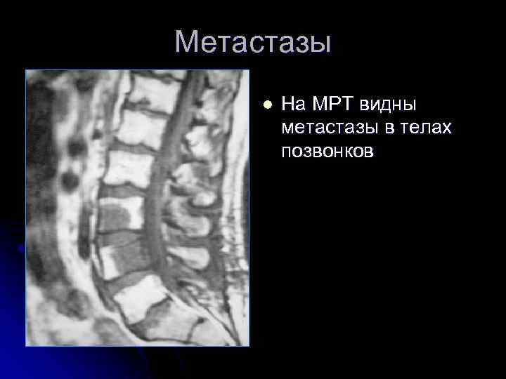 Метастазы l На МРТ видны метастазы в телах позвонков 