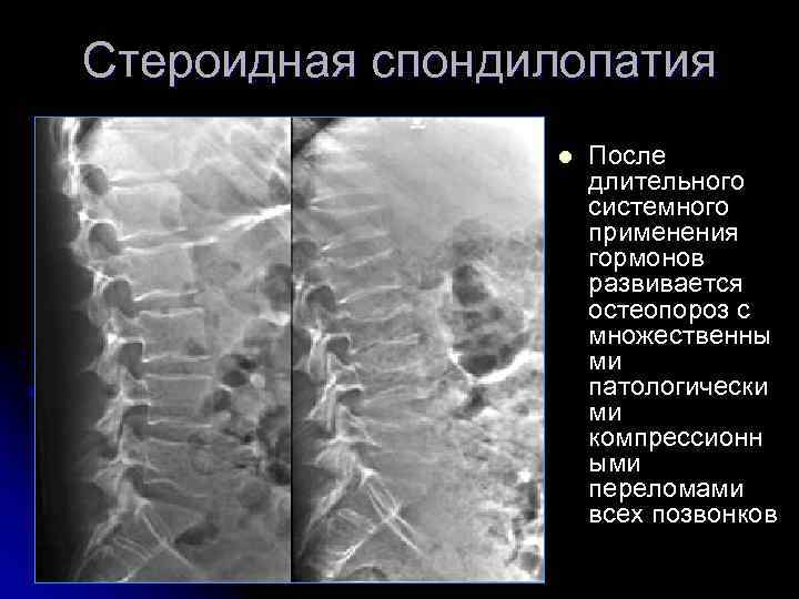 Стероидная спондилопатия l После длительного системного применения гормонов развивается остеопороз с множественны ми патологически