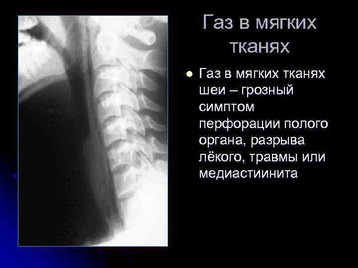 Газ в мягких тканях l Газ в мягких тканях шеи – грозный симптом перфорации