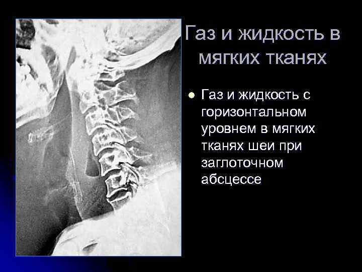 Газ и жидкость в мягких тканях l Газ и жидкость с горизонтальном уровнем в