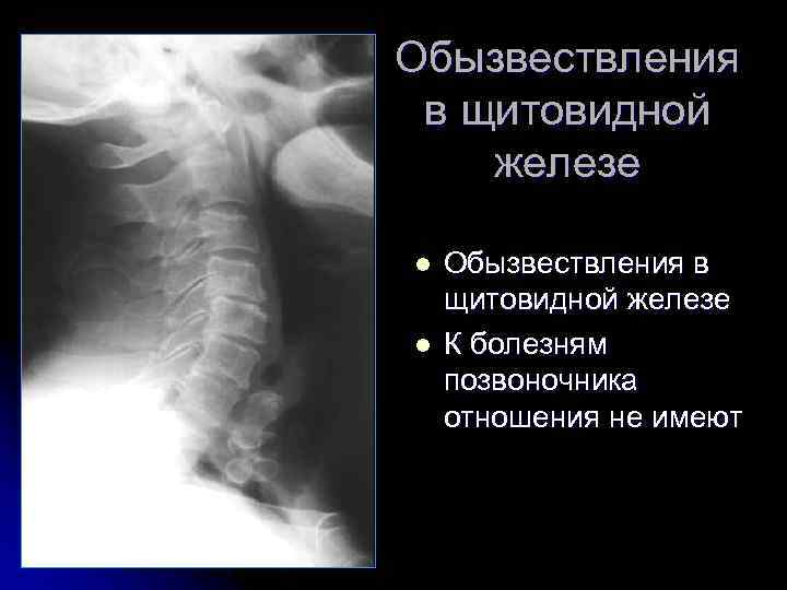 Обызвествления в щитовидной железе l l Обызвествления в щитовидной железе К болезням позвоночника отношения