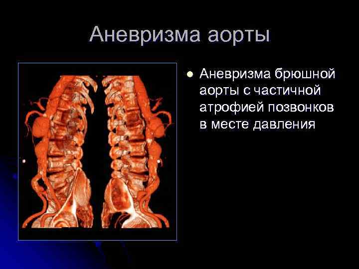 Аневризма аорты l Аневризма брюшной аорты с частичной атрофией позвонков в месте давления 