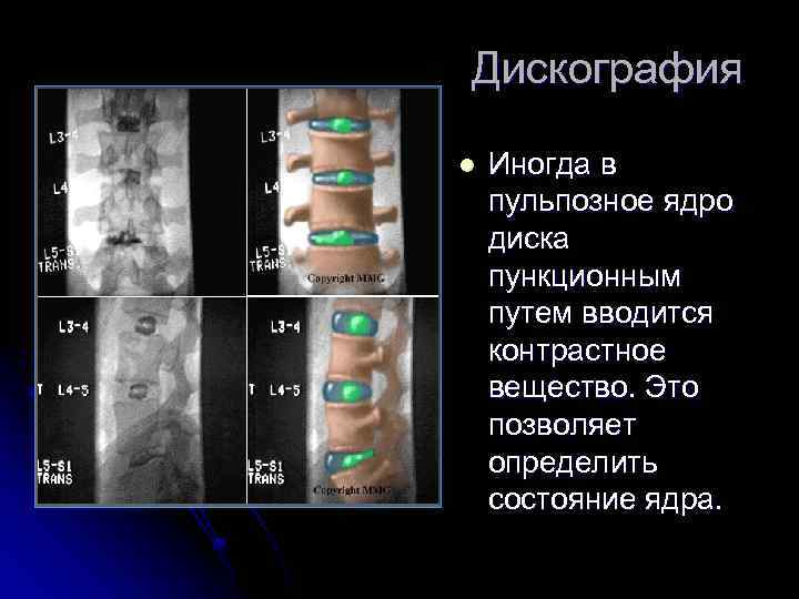 Дискография l Иногда в пульпозное ядро диска пункционным путем вводится контрастное вещество. Это позволяет