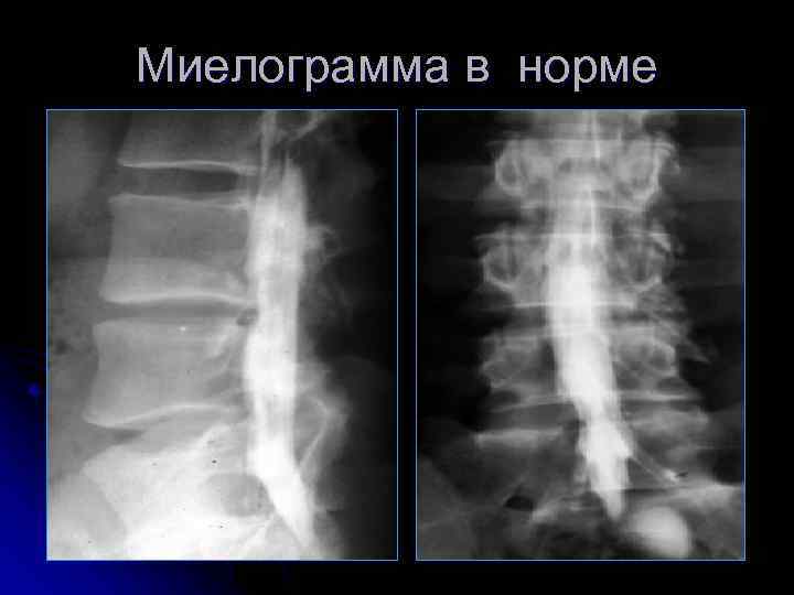 Миелограмма в норме 