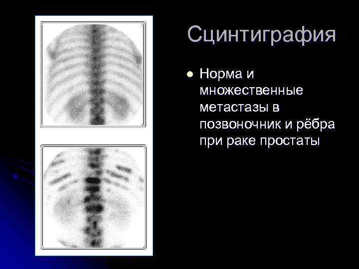 Сцинтиграфия l Норма и множественные метастазы в позвоночник и рёбра при раке простаты 