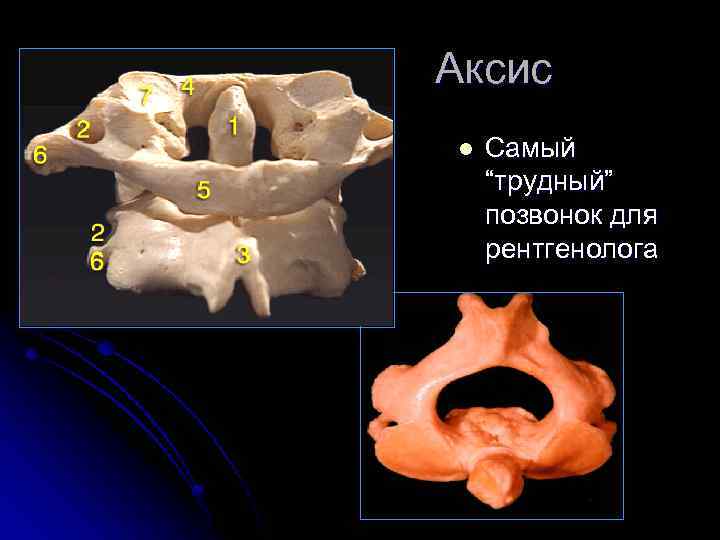 Аксис l Самый “трудный” позвонок для рентгенолога 