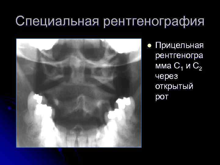 Специальная рентгенография l Прицельная рентгеногра мма С 1 и С 2 через открытый рот
