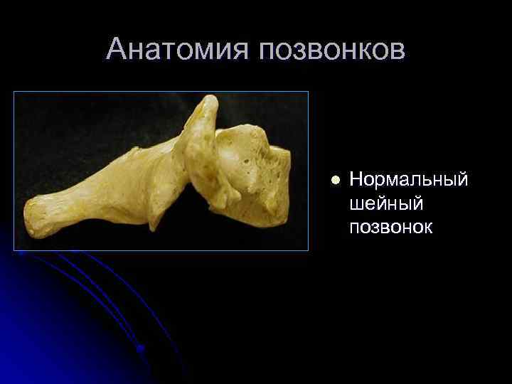 Анатомия позвонков l Нормальный шейный позвонок 