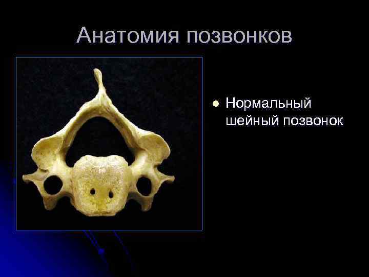 Анатомия позвонков l Нормальный шейный позвонок 