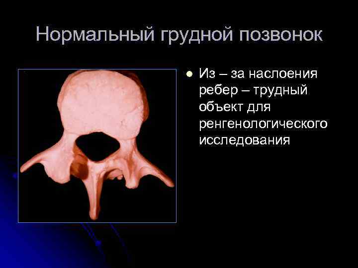 Нормальный грудной позвонок l Из – за наслоения ребер – трудный объект для ренгенологического