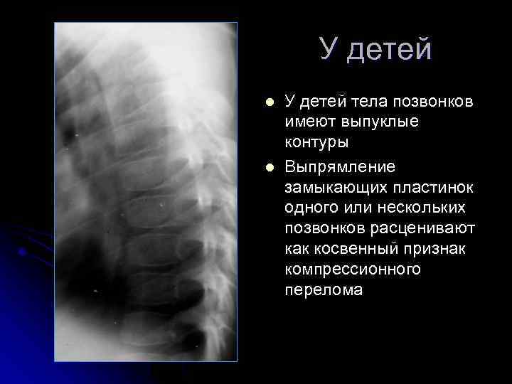 У детей l l У детей тела позвонков имеют выпуклые контуры Выпрямление замыкающих пластинок