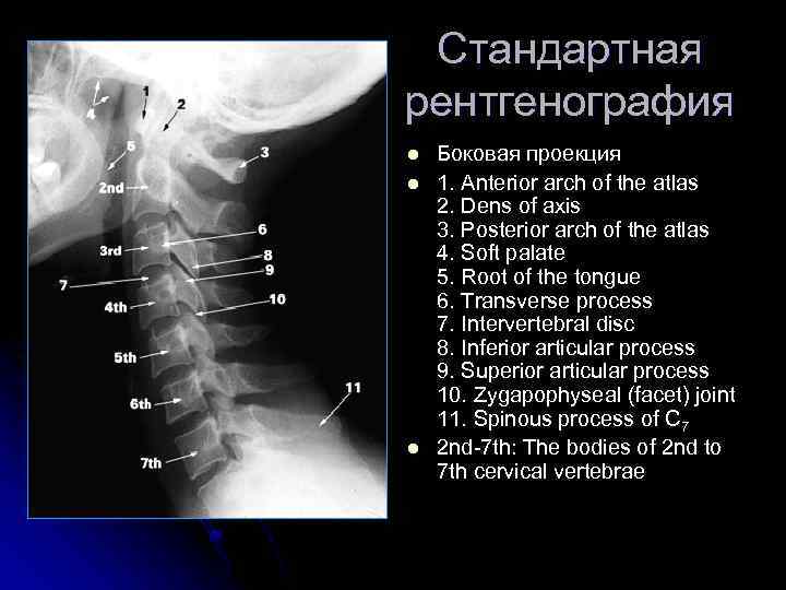 Стандартная рентгенография l l l Боковая проекция 1. Anterior arch of the atlas 2.