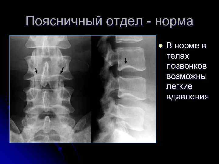 Поясничный отдел - норма l В норме в телах позвонков возможны легкие вдавления 