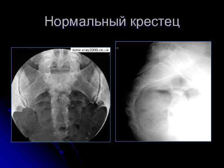 Нормальный крестец 