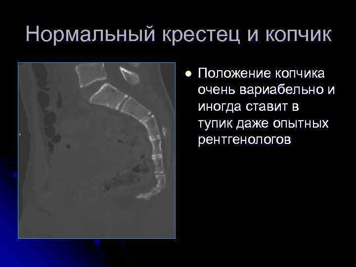 Нормальный крестец и копчик l Положение копчика очень вариабельно и иногда ставит в тупик