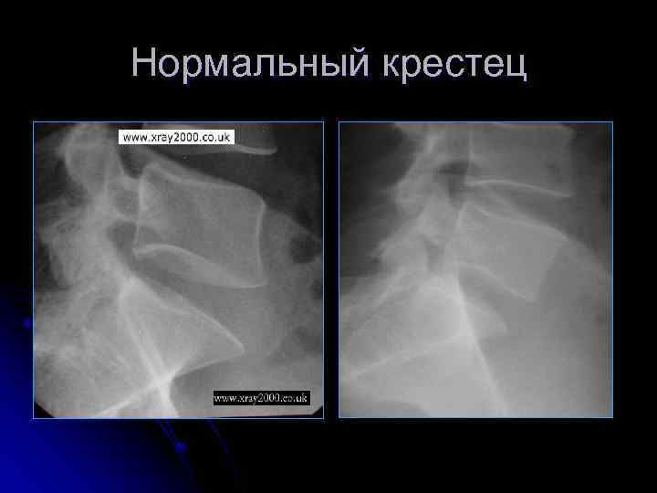 Нормальный крестец 