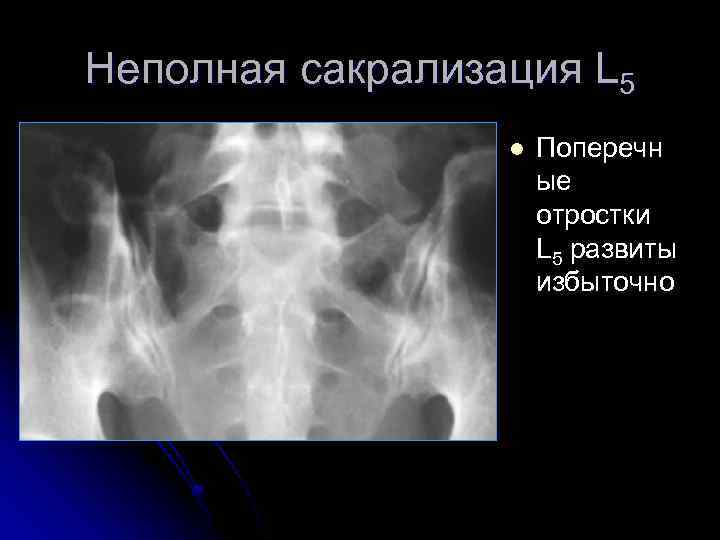 Неполная сакрализация L 5 l Поперечн ые отростки L 5 развиты избыточно 