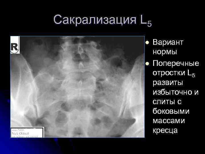Сакрализация L 5 l l Вариант нормы Поперечные отростки L 5 развиты избыточно и