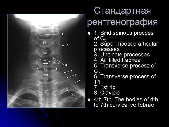 Стандартная рентгенография l l 1. Bifid spinous process of C 3 2. Superimposed articular