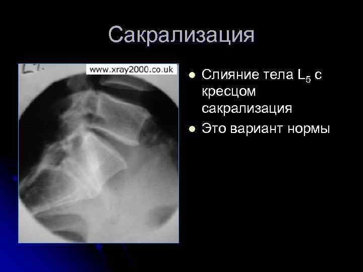 Сакрализация l l Слияние тела L 5 с кресцом сакрализация Это вариант нормы 