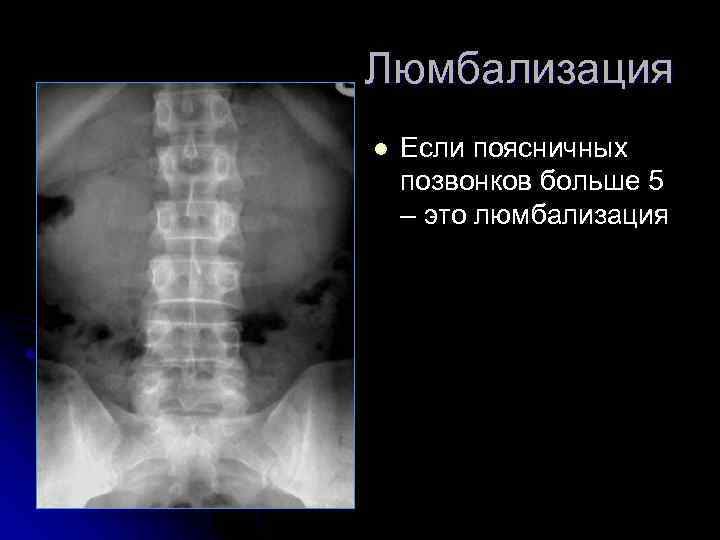 Люмбализация l Если поясничных позвонков больше 5 – это люмбализация 