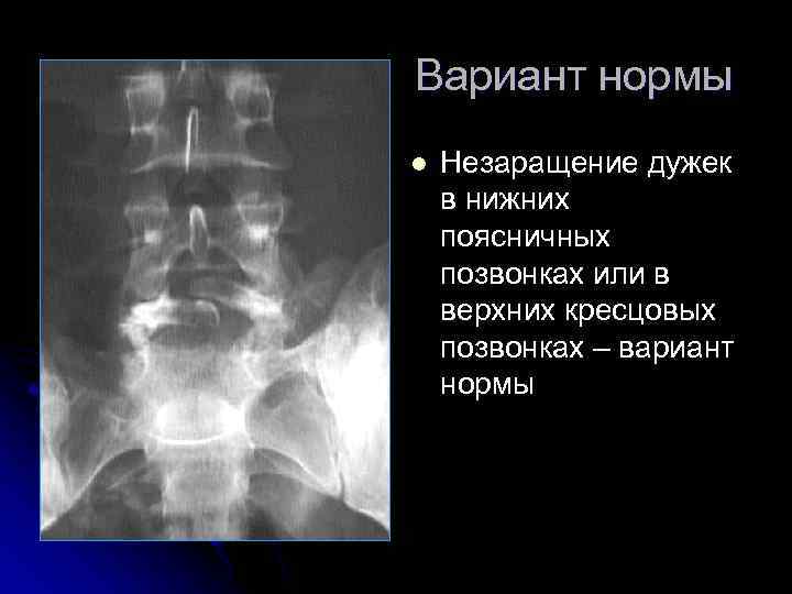 Вариант нормы l Незаращение дужек в нижних поясничных позвонках или в верхних кресцовых позвонках