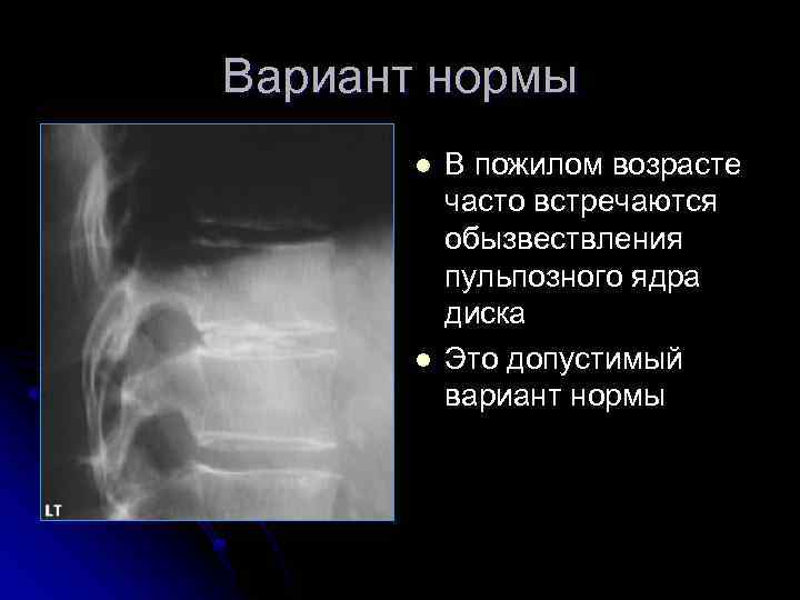 Вариант нормы l l В пожилом возрасте часто встречаются обызвествления пульпозного ядра диска Это
