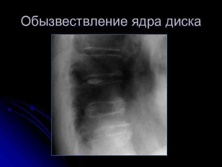 Обызвествление ядра диска 