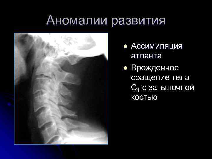 Аномалии развития l l Ассимиляция атланта Врожденное сращение тела С 1 с затылочной костью