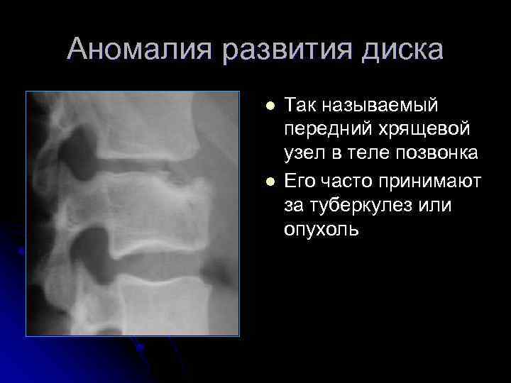 Аномалия развития диска l l Так называемый передний хрящевой узел в теле позвонка Его
