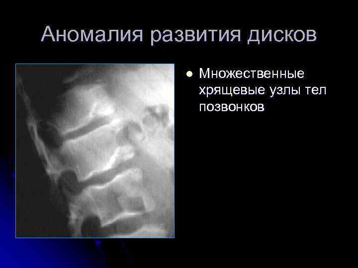 Аномалия развития дисков l Множественные хрящевые узлы тел позвонков 